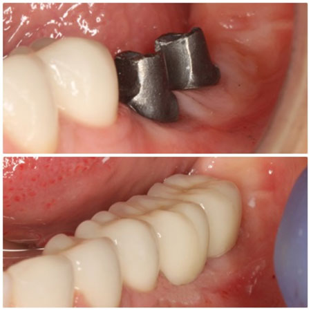 METALNA NADOGRADNJA ZUBNOG IMPLANTATA